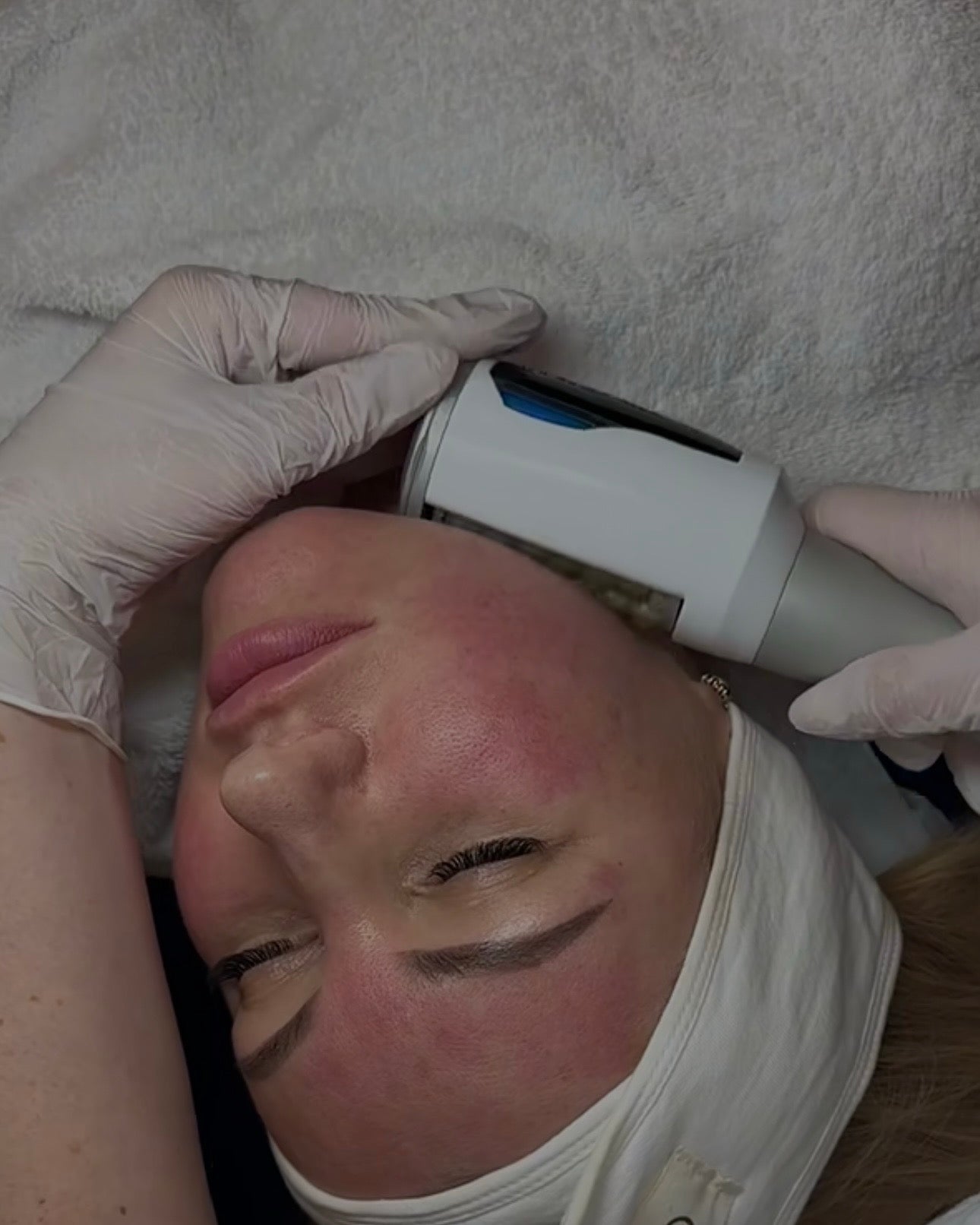 18. ENDOSPHERES VISO (1 SEDUTA)