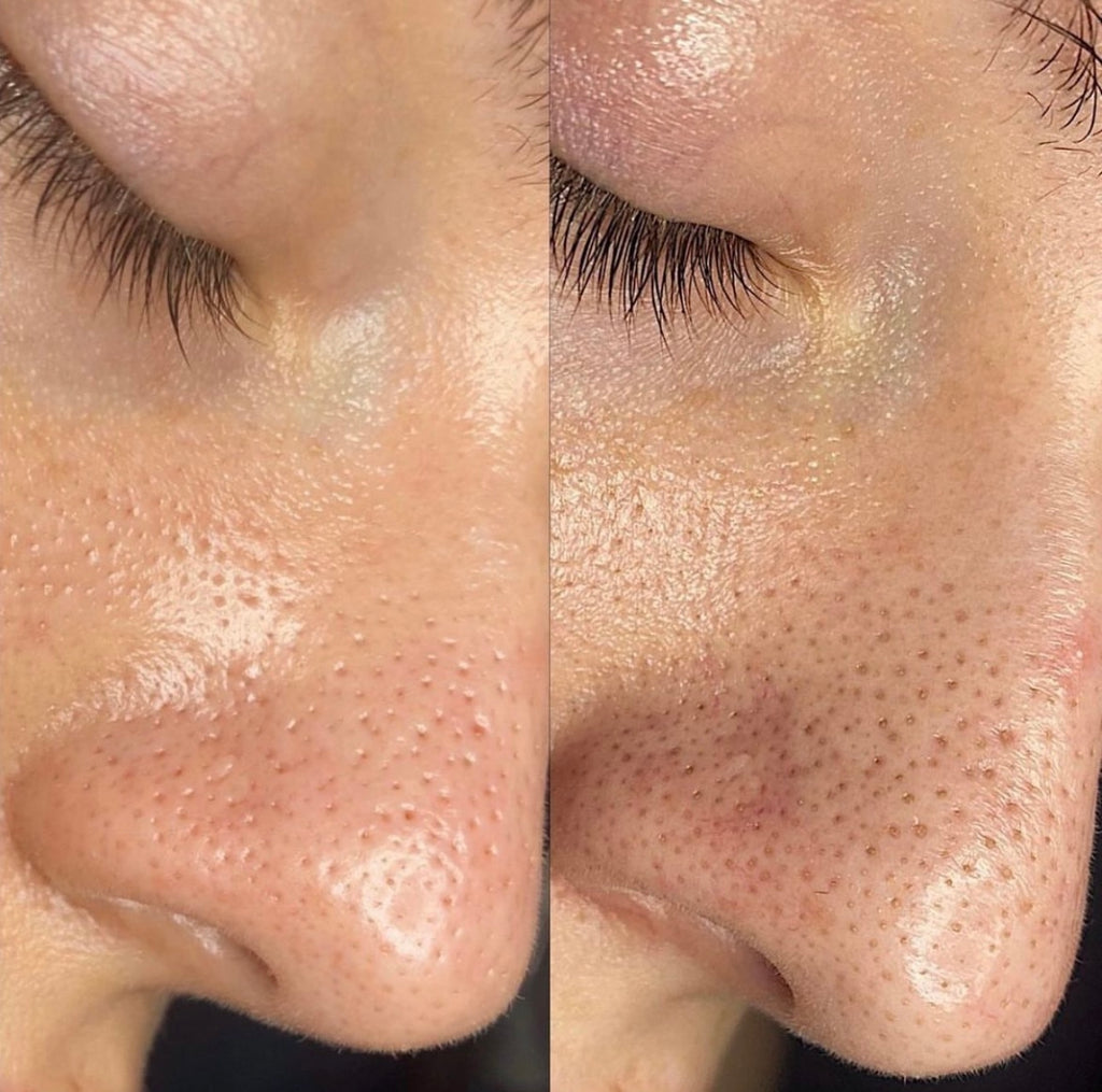 PULIZIA DEL VISO CON MICRODERMABRASIONE