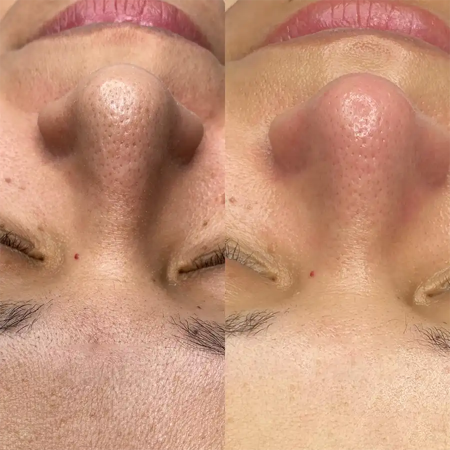 PULIZIA DEL VISO CON MICRODERMABRASIONE