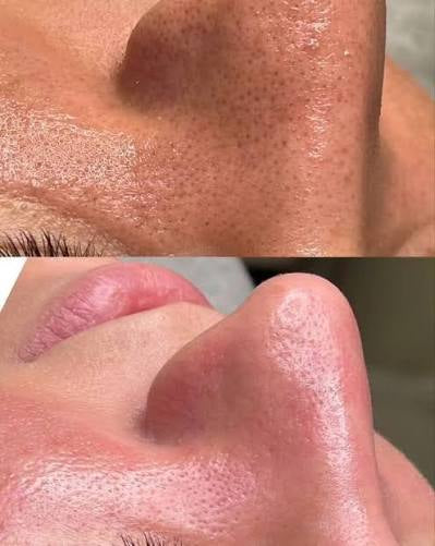 PULIZIA DEL VISO CON MICRODERMABRASIONE